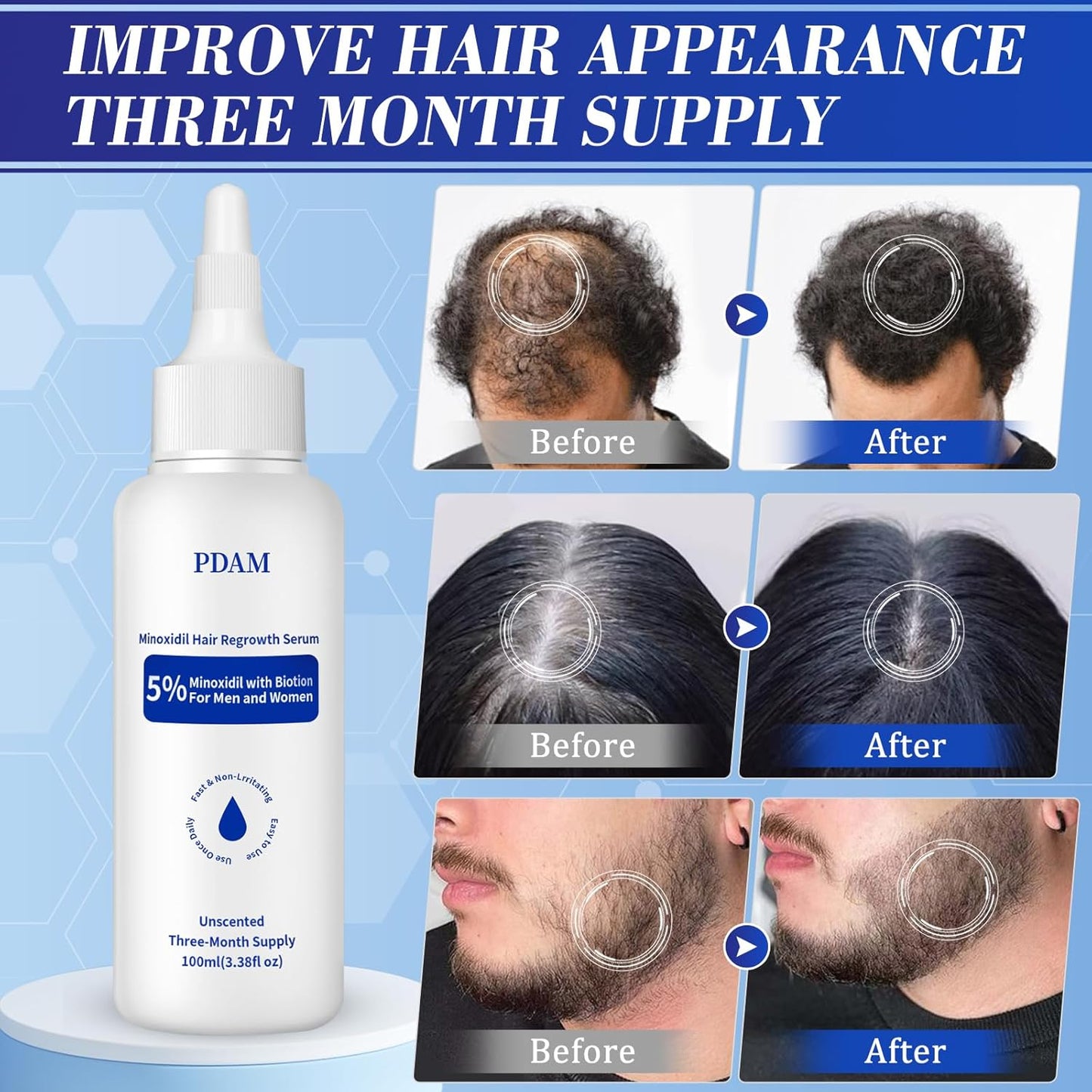 Minoxidil Hair Growth Serum - 100 ML for Men & Women, 5% Minoxidil for Beard & Hair Loss Treatment